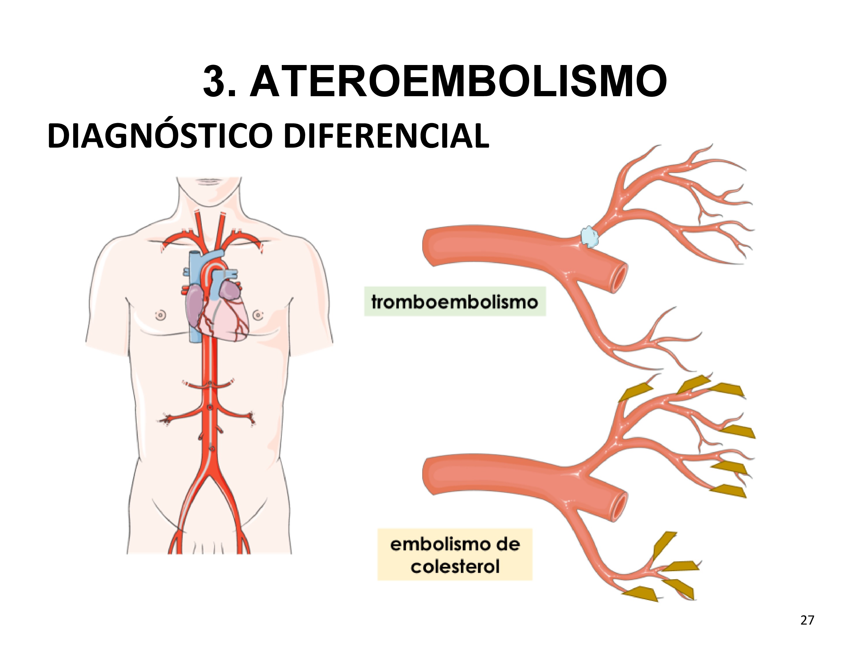 Dentro del diagnóstico diferencial estaría el tromboembolismo. La diferencia radica en la extensión de la isquemia y la región afecta. El tromboembolismo generalmente afecta a arterias de mayor calibre, generando isquemia en el lecho distal y puede verse en un TC (dependiendo del tamaño y localización) y además puede tener tratamiento con fibrinólisis o trombectomía. En cambio, el embolismo de colesterol afecta a lechos distales ya que los cristales son microscópicos, por lo cual no se evidencia en un TC y la recuperación es peor dado el infiltrado inflamatorio asociado que produce.