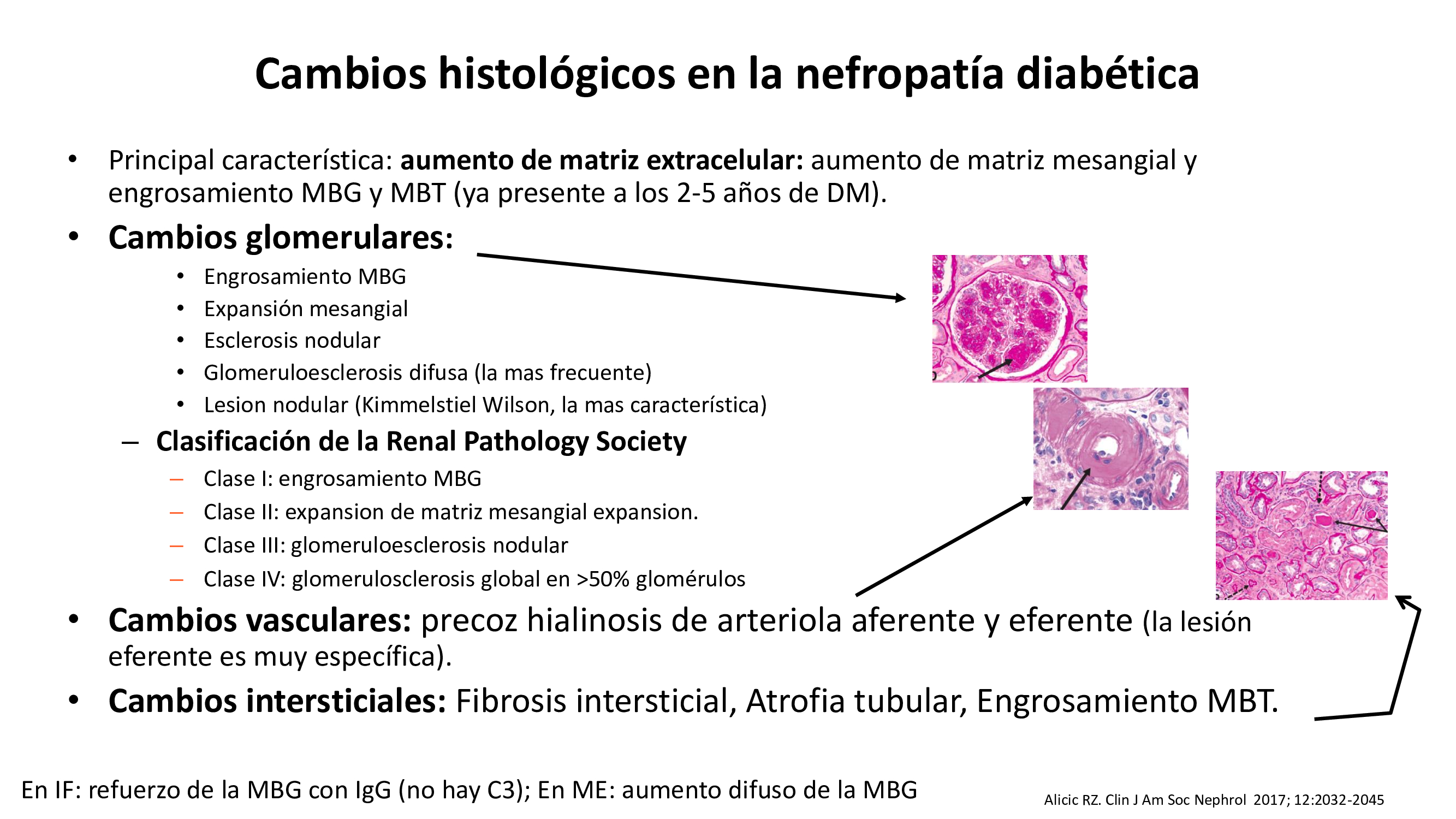 En el contexto de vías patogénicas diferentes se desarrollan las lesiones glomerulares y tubulointersticiales que dan lugar a los cambios de la nefropatía diabética.
La enfermedad renal diabética induce cambios estructurales tanto en glomérulo como en tubulos.
Cambios glomerulares:

Engrosamiento MBG
Expansión mesangial
Esclerosis nodular

Y cambios tubulointersticiales:

Fibrosis intersticial
Atrofia tubular
Engrosamiento de MBT

En el contexto de vías patogénicas diferentes se desarrollan las lesiones glomerulares y tubulointersticiales que dan lugar a los cambios de la nefropatía diabética.

IF: refuerzo de MBG con IgG (no hay C3)
ME: aumento difuso de la MBG

Different pathways and networks involved in the initiation and progression of diabetic kidney disease. AGE, advanced glycation end product; CTGF, connective tissue growth factor; JAKSTAT, Janus kinase/signal transducer and activator of transcription; PKC, protein kinase C; RAAS, renin-angiotensin-aldosterone system; ROS, reactive oxygen species; SAA, serum amyloid A; VEGF-A, vascular endothelial growth factor A. *JAK/STAT signaling can be unchanged (¿) or upregulated (¿) in early and later stages of diabetes, respectively.