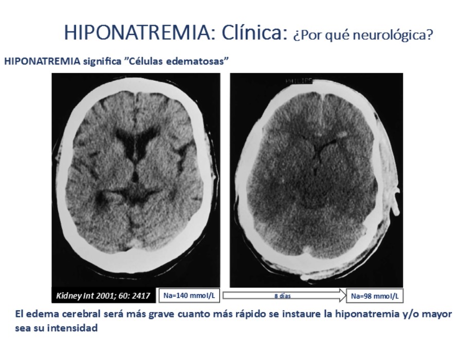 Esta es la explicación gráfica del edema cerebral que se produce en la hiponatremia.
