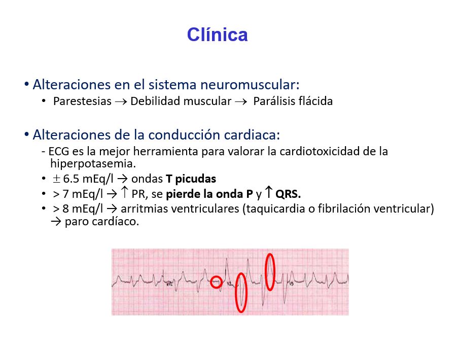 La clínica de la hiperpotasemia se produce fundamentalmente a nivel de:

El sistema neuromuscular:

Parestesias --> Debilidad muscular --> Parálisis flácida




La conducción cardiaca: 

ECG es la mejor herramienta para valorar la cardiotoxicidad de la hiperpotasemia. 
 6.5 mEq/l --> ondas T picudas
> 7 mEq/l --> Aumenta PR, se pierde la onda P y aumenta QRS. 
> 8 mEq/l --> arritmias ventriculares (taquicardia o fibrilación ventricular) --> paro cardíaco. 


